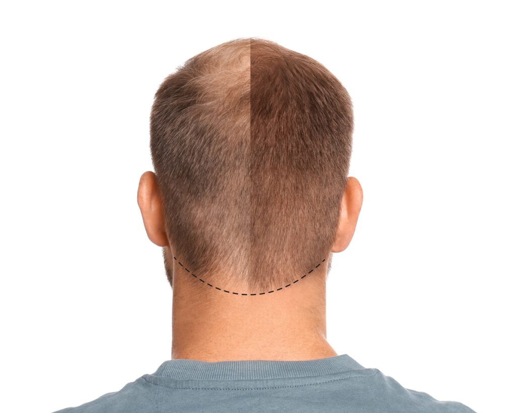 Recupera tu cabello con un trasplante capilar en Sevilla