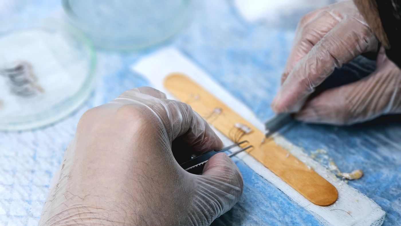 Unidades foliculares preparadas una a una antes de implantarlas en la linea frontal